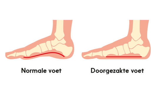 Zooltjes voor best sale doorgezakte voeten